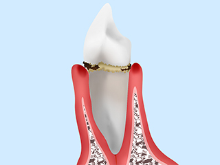 軽度歯周炎（歯肉炎）