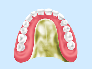 自費入れ歯