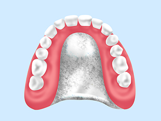 チタン床義歯