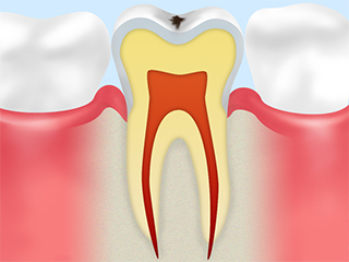 CO　初期の虫歯