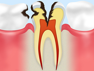 C3　神経の虫歯
