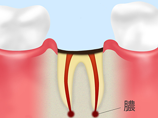 C4　歯根の虫歯