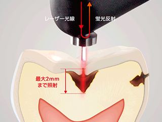 レーザー光で虫歯の状態を確認